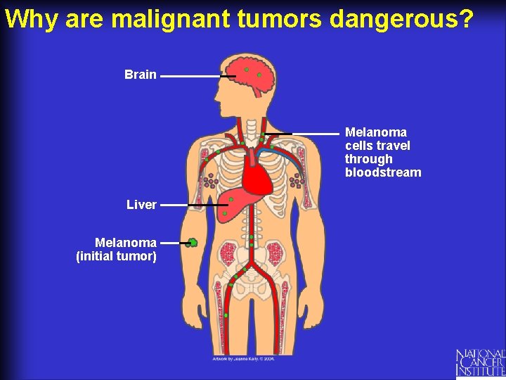 Why are malignant tumors dangerous? Brain Melanoma cells travel through bloodstream Liver Melanoma (initial