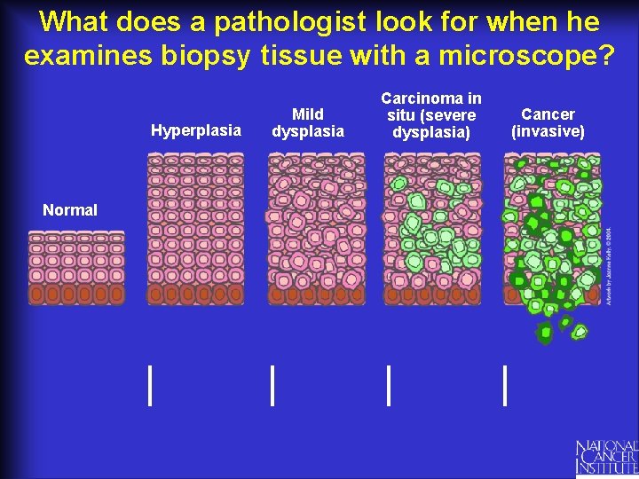 What does a pathologist look for when he examines biopsy tissue with a microscope?