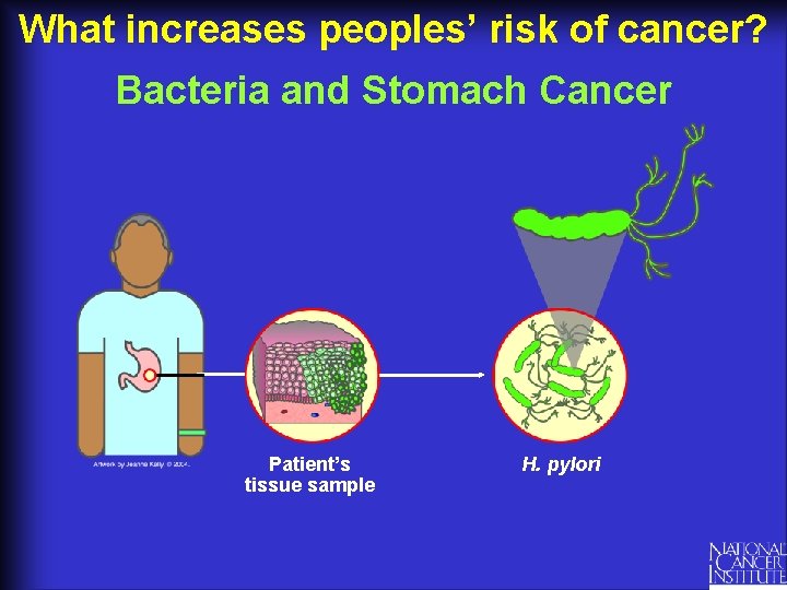 What increases peoples’ risk of cancer? Bacteria and Stomach Cancer Patient’s tissue sample H.