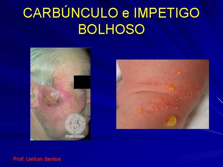 CARBÚNCULO e IMPETIGO BOLHOSO Prof. Ueliton Santos 