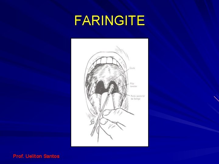 FARINGITE Prof. Ueliton Santos 