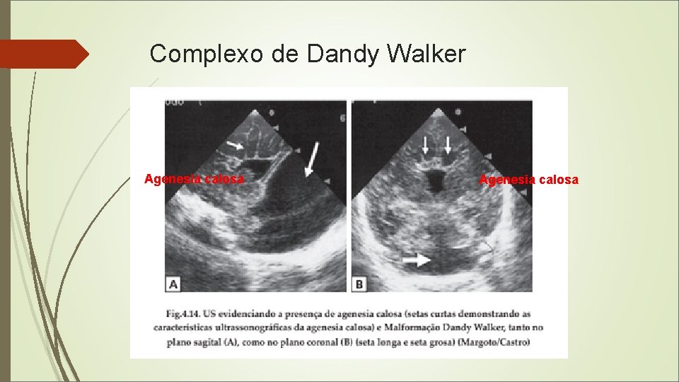 Complexo de Dandy Walker Agenesia calosa 