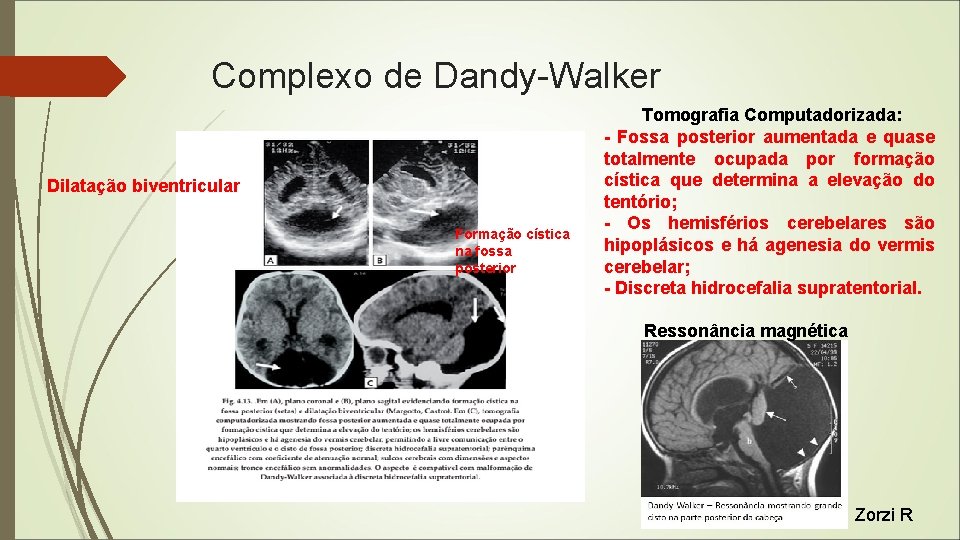 Complexo de Dandy-Walker Dilatação biventricular Formação cística na fossa posterior Tomografia Computadorizada: - Fossa