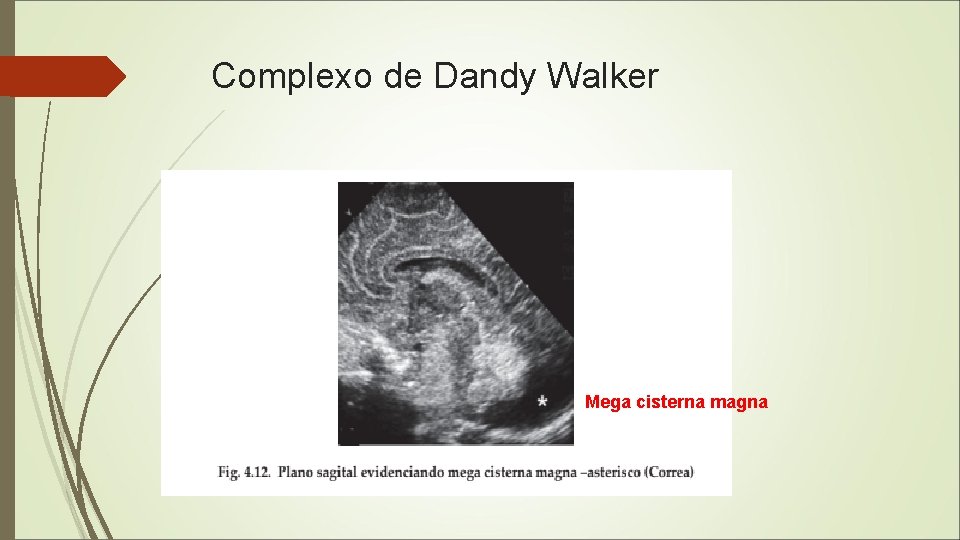 Complexo de Dandy Walker Mega cisterna magna 