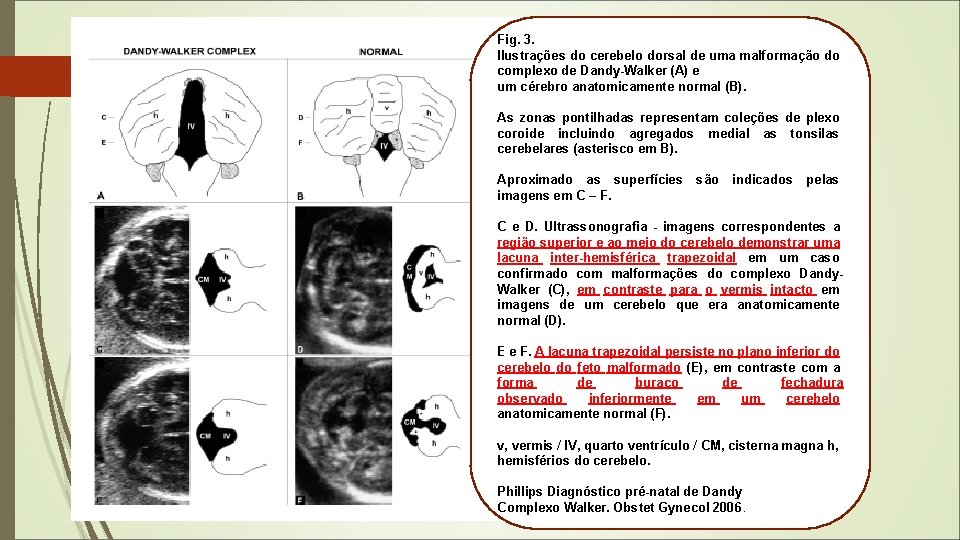 Fig. 3. Ilustrações do cerebelo dorsal de uma malformação do complexo de Dandy-Walker (A)