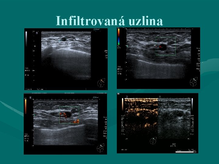 Infiltrovaná uzlina 