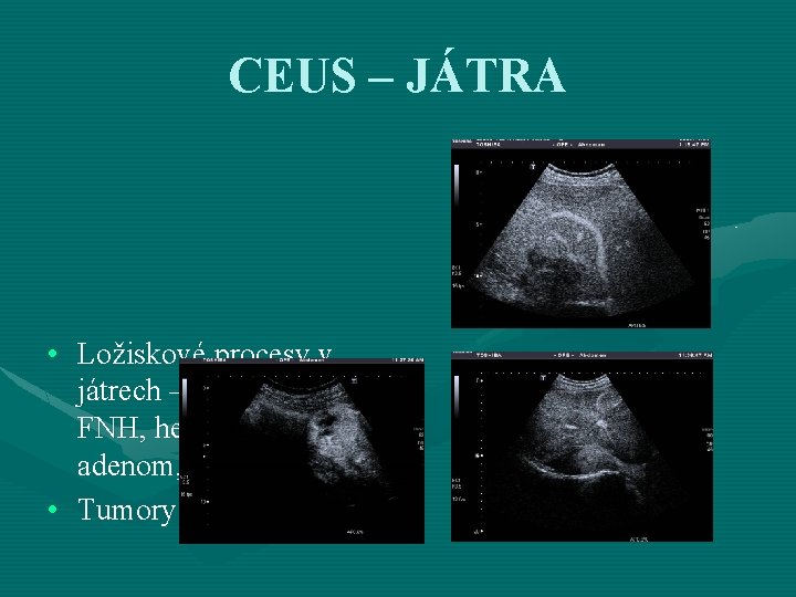 CEUS – JÁTRA • Ložiskové procesy v játrech – metastáza, FNH, hemangiom, adenom, …