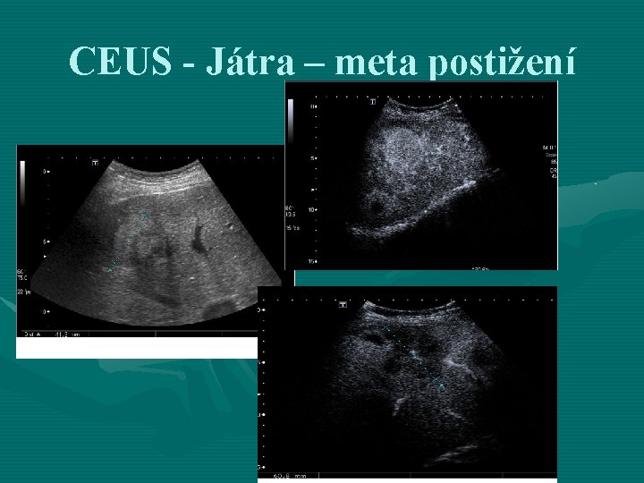 CEUS - Játra – meta postižení 