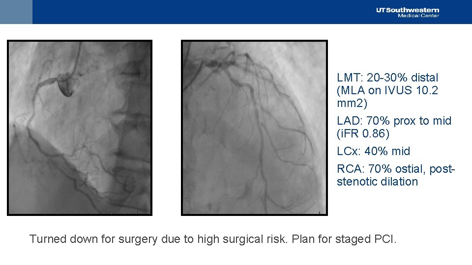 LMT: 20 -30% distal (MLA on IVUS 10. 2 mm 2) LAD: 70% prox