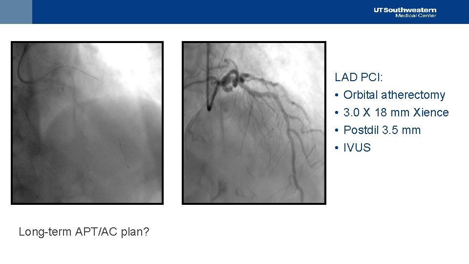 LAD PCI: • Orbital atherectomy • 3. 0 X 18 mm Xience • Postdil