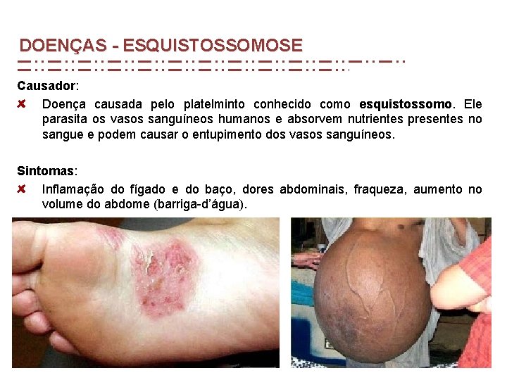 DOENÇAS - ESQUISTOSSOMOSE Causador: Doença causada pelo platelminto conhecido como esquistossomo. Ele parasita os DOENÇAS - ESQUISTOSSOMOSE Causador: Doença causada pelo platelminto conhecido como esquistossomo. Ele parasita os