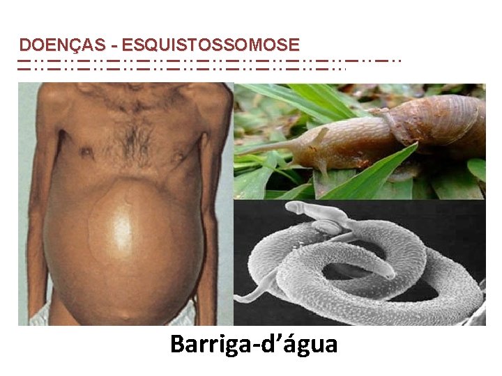 DOENÇAS - ESQUISTOSSOMOSE Barriga-d’água DOENÇAS - ESQUISTOSSOMOSE Barriga-d’água