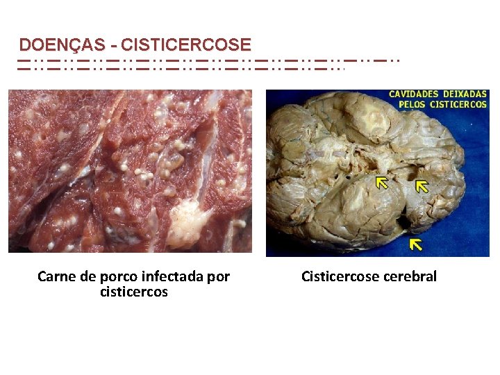 DOENÇAS - CISTICERCOSE Carne de porco infectada por cisticercos Cisticercose cerebral DOENÇAS - CISTICERCOSE Carne de porco infectada por cisticercos Cisticercose cerebral