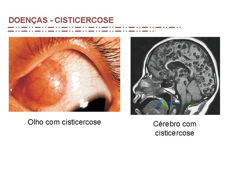 DOENÇAS - CISTICERCOSE Olho com cisticercose Cérebro com cisticercose DOENÇAS - CISTICERCOSE Olho com cisticercose Cérebro com cisticercose
