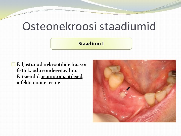 Osteonekroosi staadiumid Staadium I � Paljastunud nekrootiline luu või fistli kaudu sondeeritav luu. Patsiendid