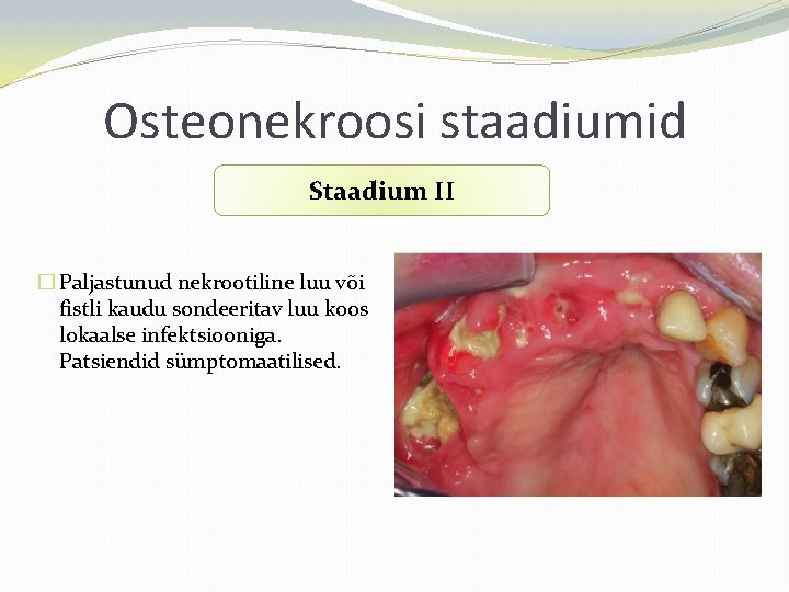 Osteonekroosi staadiumid Staadium II � Paljastunud nekrootiline luu või fistli kaudu sondeeritav luu koos