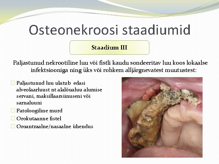 Osteonekroosi staadiumid Staadium III Paljastunud nekrootiline luu või fistli kaudu sondeeritav luu koos lokaalse