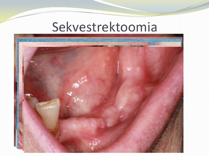 Sekvestrektoomia 