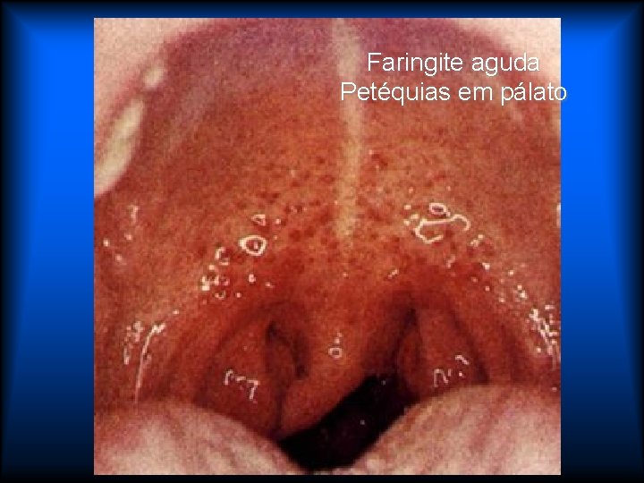 Faringite aguda Petéquias em pálato 