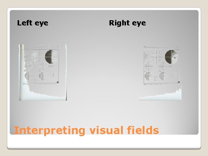 Left eye Right eye Interpreting visual fields 