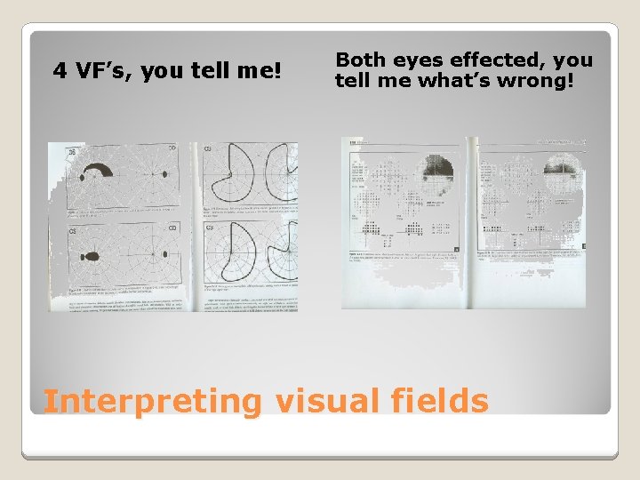 4 VF’s, you tell me! Both eyes effected, you tell me what’s wrong! Interpreting