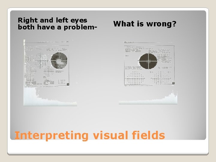Right and left eyes both have a problem- What is wrong? Interpreting visual fields