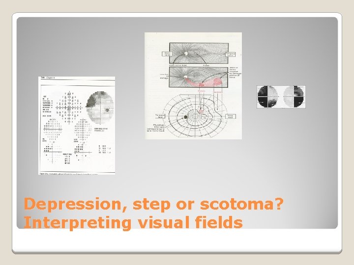 Depression, step or scotoma? Interpreting visual fields 