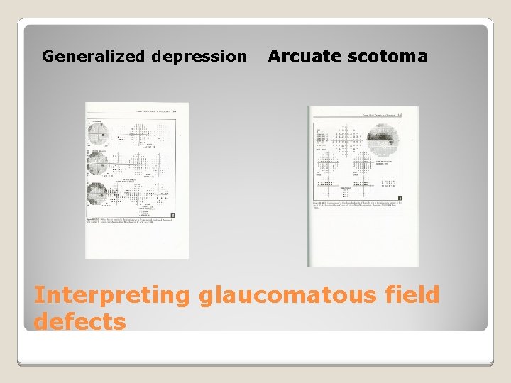 Generalized depression Arcuate scotoma Interpreting glaucomatous field defects 