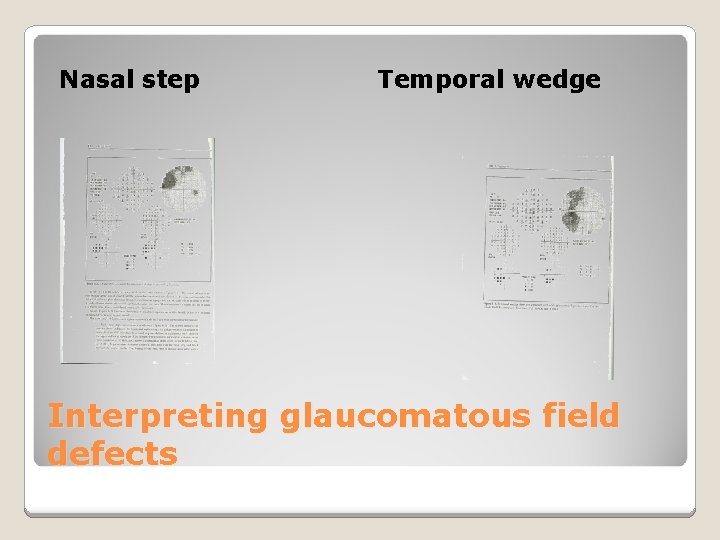 Nasal step Temporal wedge Interpreting glaucomatous field defects 