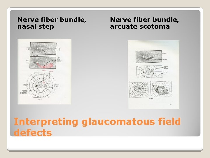 Nerve fiber bundle, nasal step Nerve fiber bundle, arcuate scotoma Interpreting glaucomatous field defects