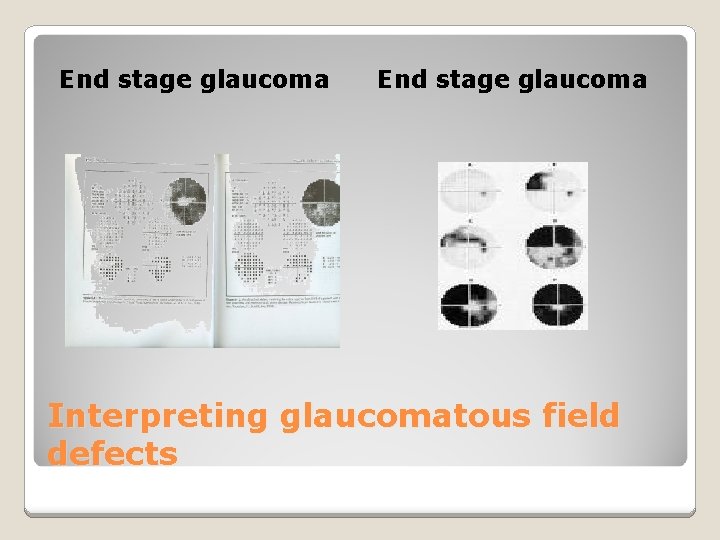 End stage glaucoma Interpreting glaucomatous field defects End stage glaucoma Interpreting glaucomatous field defects