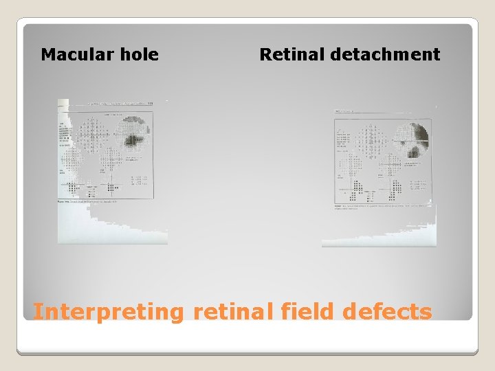 Macular hole Retinal detachment Interpreting retinal field defects 