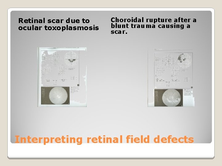 Retinal scar due to ocular toxoplasmosis Choroidal rupture after a blunt trauma causing a