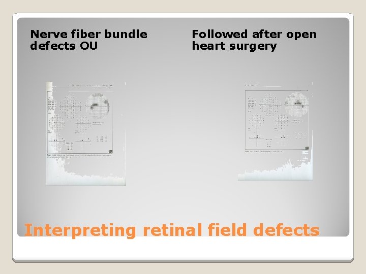 Nerve fiber bundle defects OU Followed after open heart surgery Interpreting retinal field defects