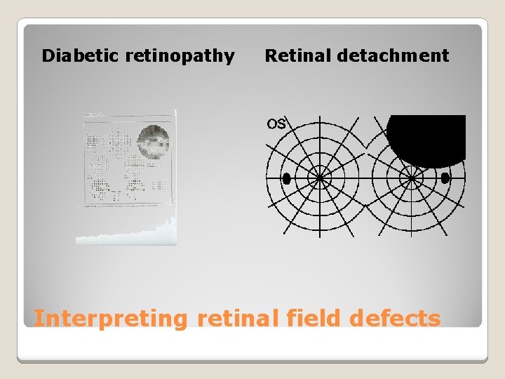 Diabetic retinopathy Retinal detachment Interpreting retinal field defects 