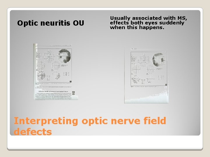 Optic neuritis OU Usually associated with MS, effects both eyes suddenly when this happens.