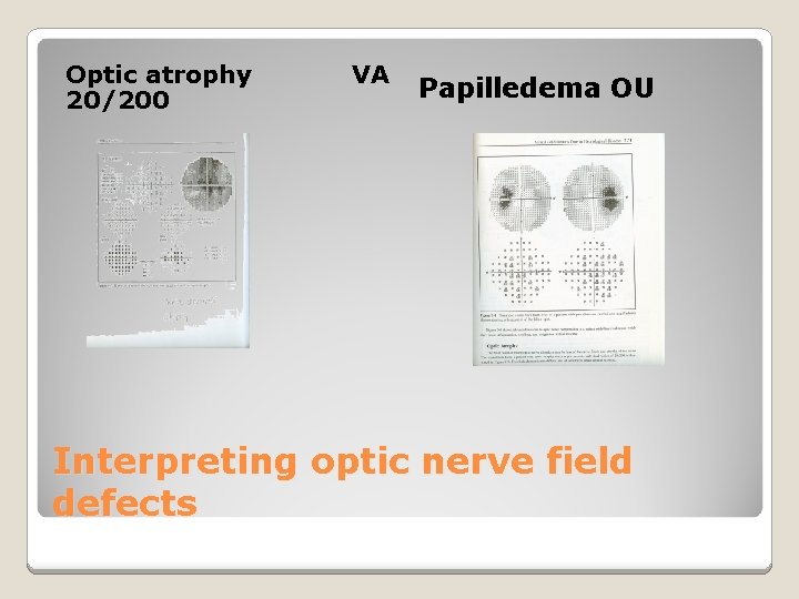 Optic atrophy 20/200 VA Papilledema OU Interpreting optic nerve field defects 