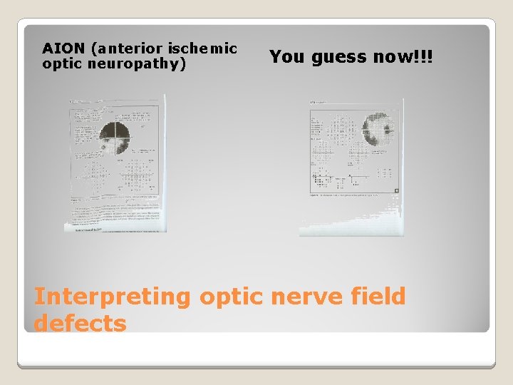 AION (anterior ischemic optic neuropathy) You guess now!!! Interpreting optic nerve field defects 