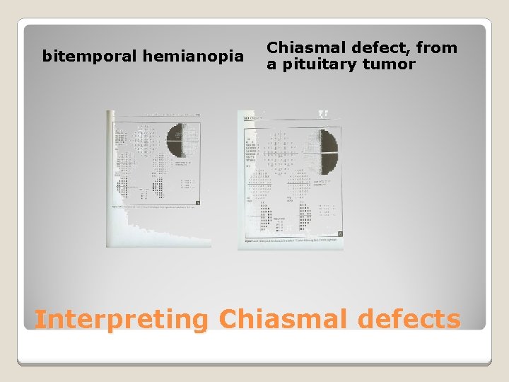 bitemporal hemianopia Chiasmal defect, from a pituitary tumor Interpreting Chiasmal defects 