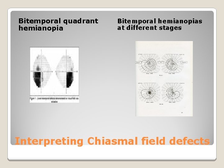 Bitemporal quadrant hemianopia Bitemporal hemianopias at different stages Interpreting Chiasmal field defects 