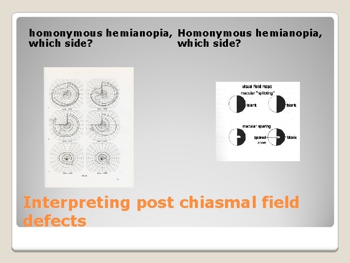 homonymous hemianopia, Homonymous hemianopia, which side? Interpreting post chiasmal field defects 