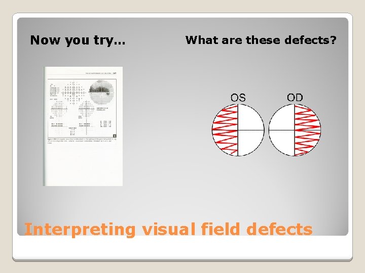 Now you try… What are these defects? Interpreting visual field defects 