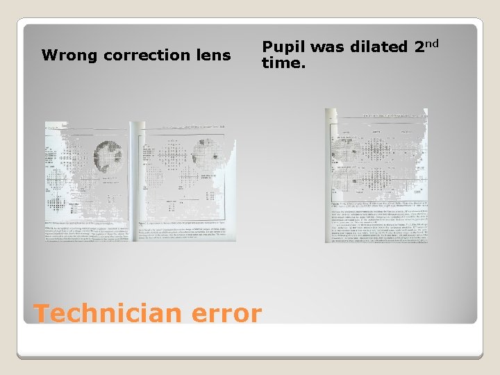 Wrong correction lens Pupil was dilated 2 nd time. Technician error 