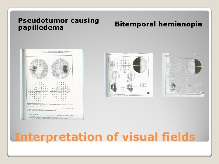 Pseudotumor causing papilledema Bitemporal hemianopia Interpretation of visual fields 