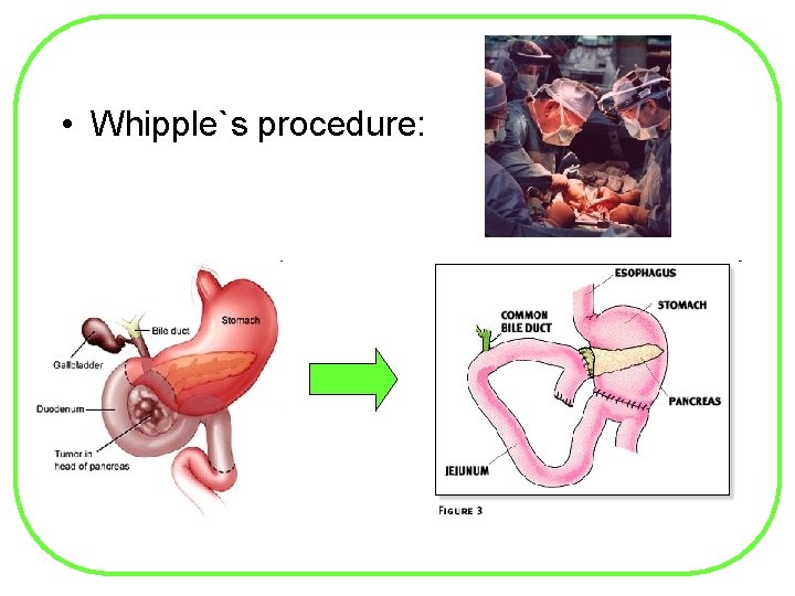  • Whipple`s procedure: 