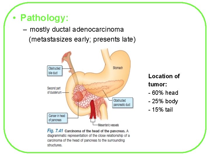  • Pathology: – mostly ductal adenocarcinoma (metastasizes early; presents late) Location of tumor: