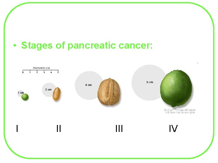  • Stages of pancreatic cancer: I II IV 