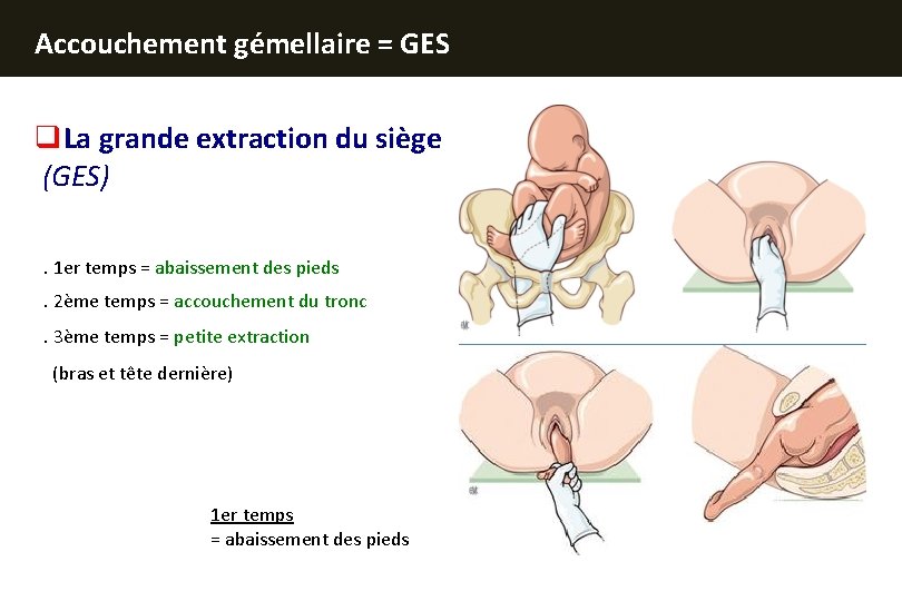 Accouchement gémellaire = GES q. La grande extraction du siège (GES) . 1 er