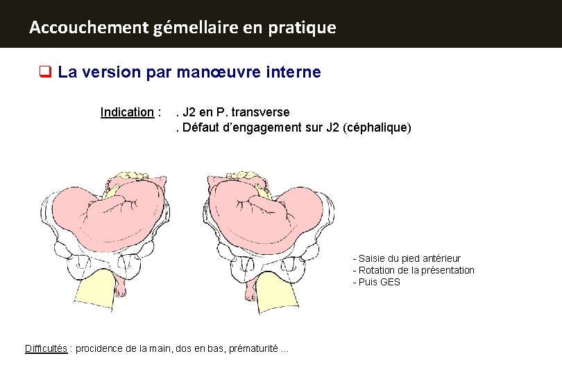 Accouchement gémellaire en pratique q La version par manœuvre interne Indication : . J