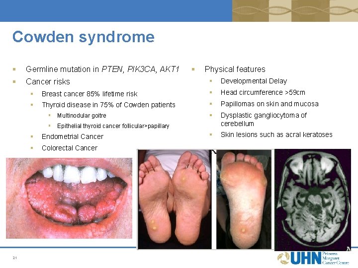 Cowden syndrome § Germline mutation in PTEN, PIK 3 CA, AKT 1 § Cancer Cowden syndrome § Germline mutation in PTEN, PIK 3 CA, AKT 1 § Cancer